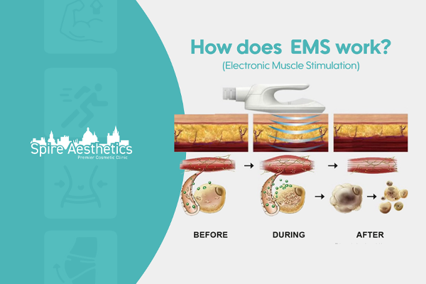 EMS treatment for post pregnancy weight loss treatment Gloucestershire