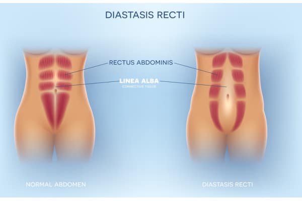 What Non-Surgical Options Are Available for Diastasis Recti Gloucestershire ?