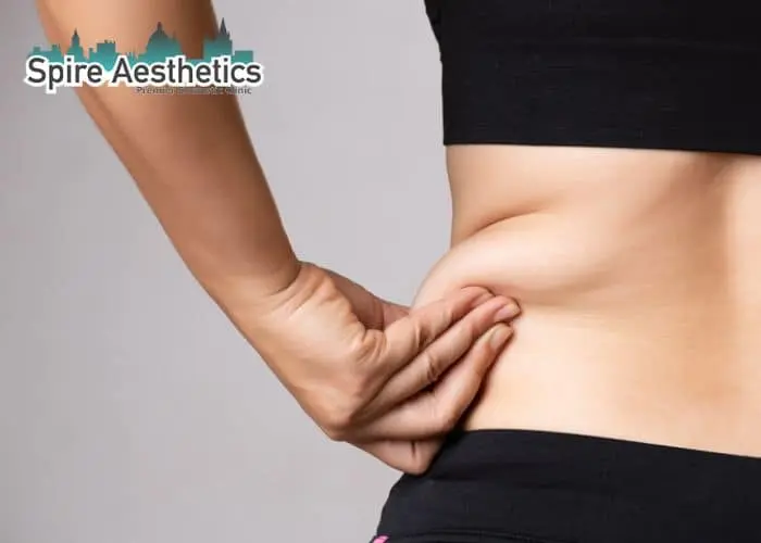 Image of woman pinching fat on their hips Gloucestershire . Fat Freezing treatment