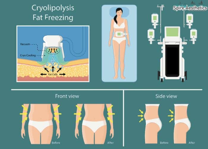 Image of diet and fat freezing combined for best results for Spire Aesthetics Gloucestershire