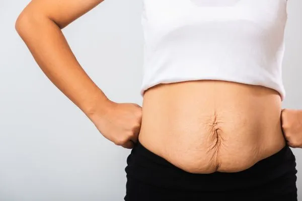 Image of a woman's stomach after weight loss with sagging skin following a gastric band Gloucestershire