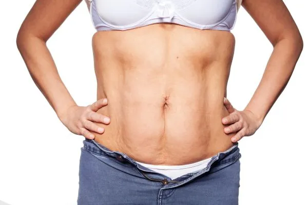 sagging skin on woman's stomach after weight loss injections Gloucestershire