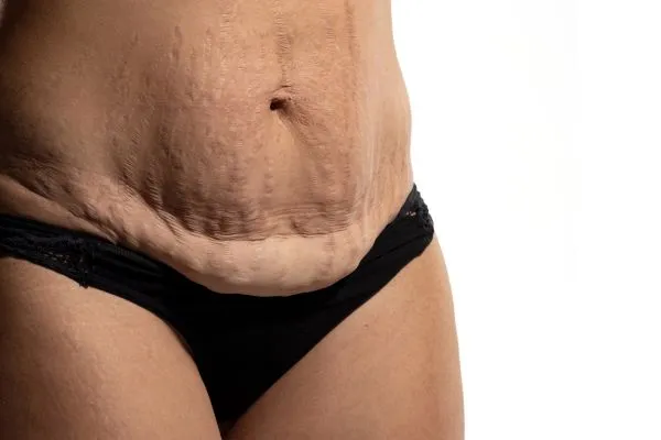 Image of womans stomach after weight loss injections Gloucestershire showing saggy skin