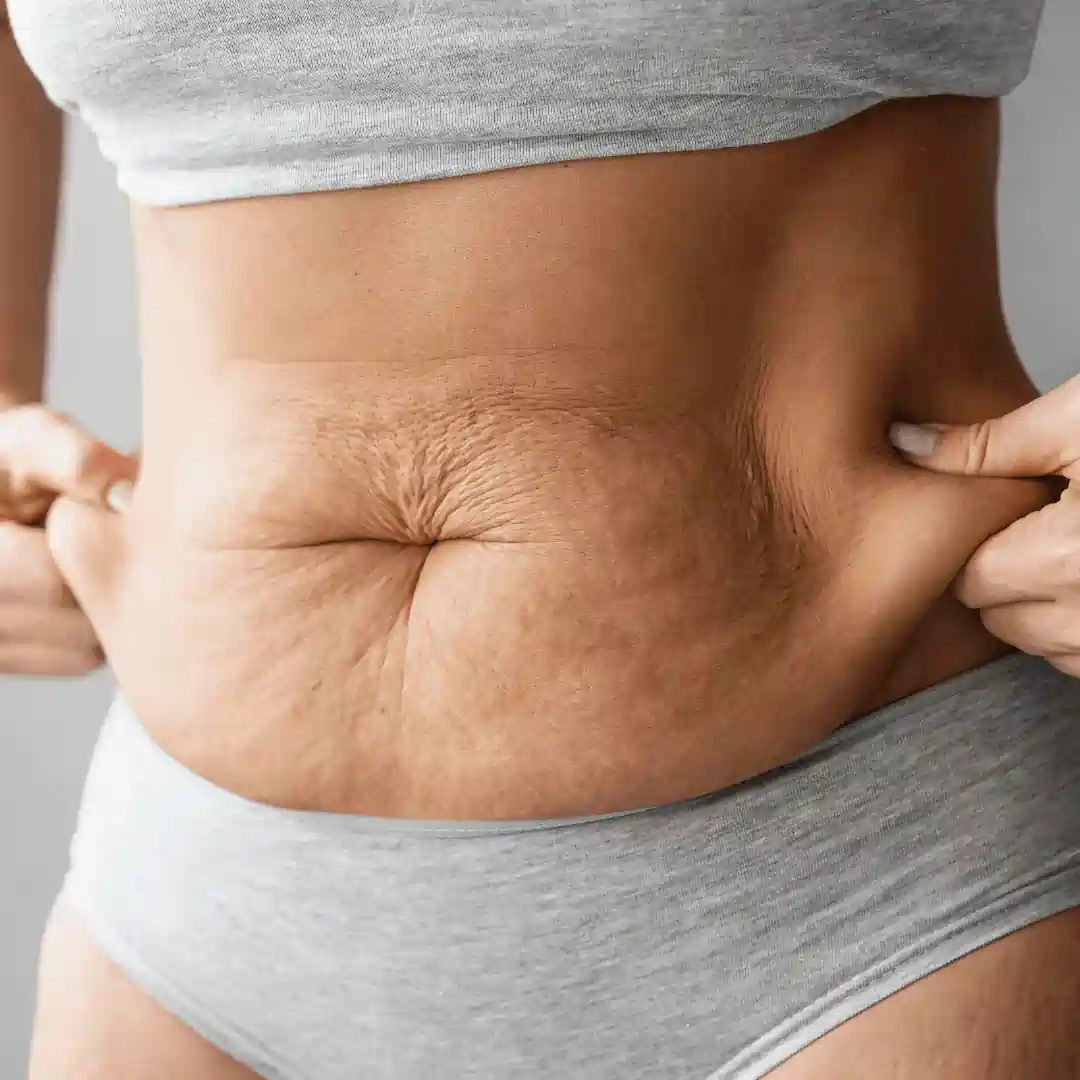 Is It Normal to Have Loose Skin After Pregnancy Gloucestershire ?