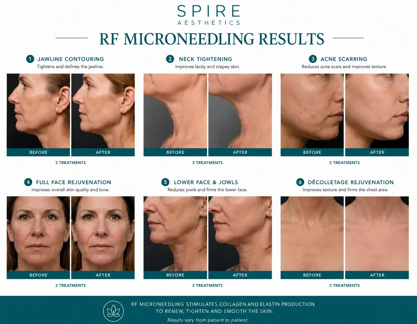 RF Microneedling Skin tightening Gloucestershire results