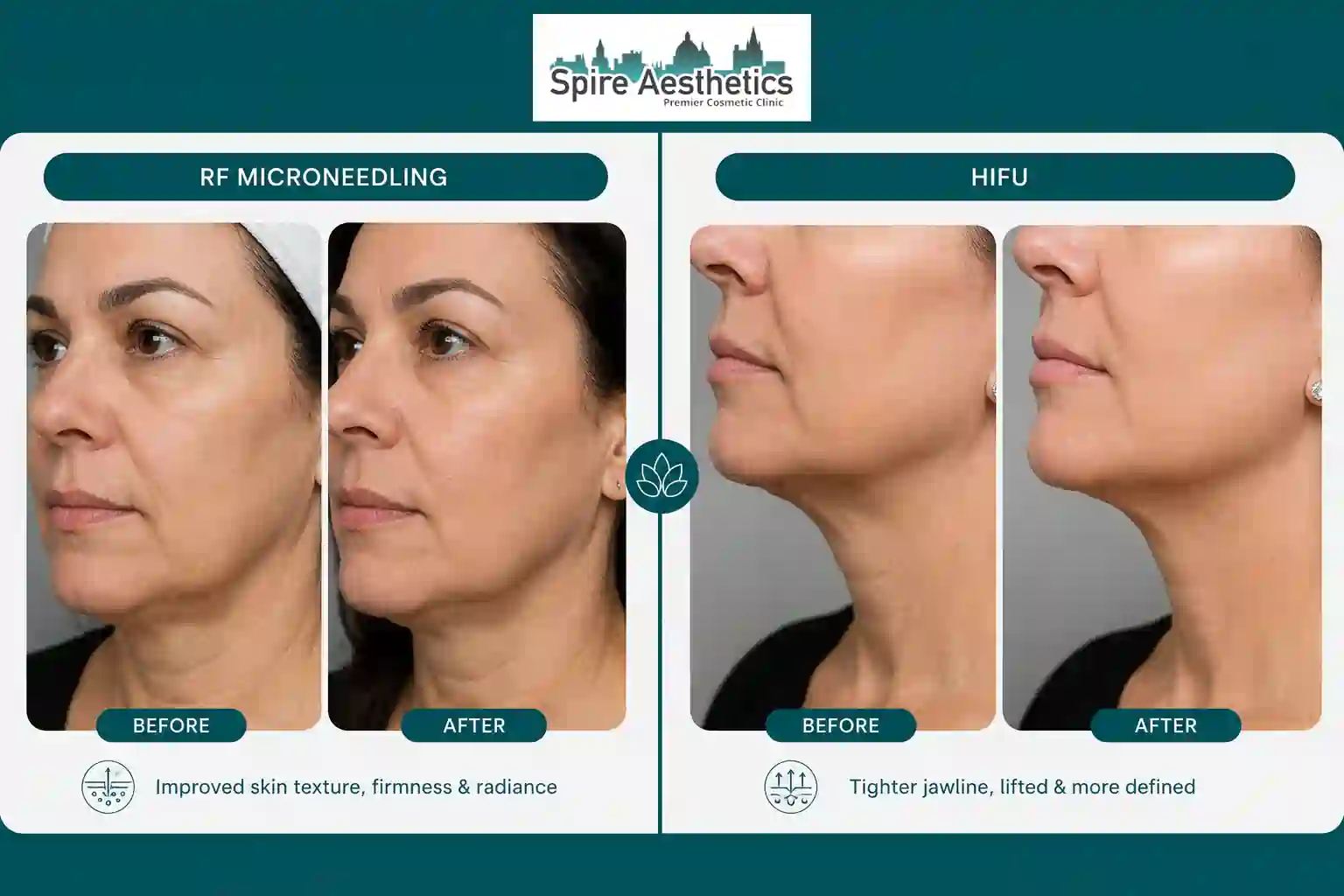 Can RF Microneedling and HIFU Be Combined Gloucestershire ?