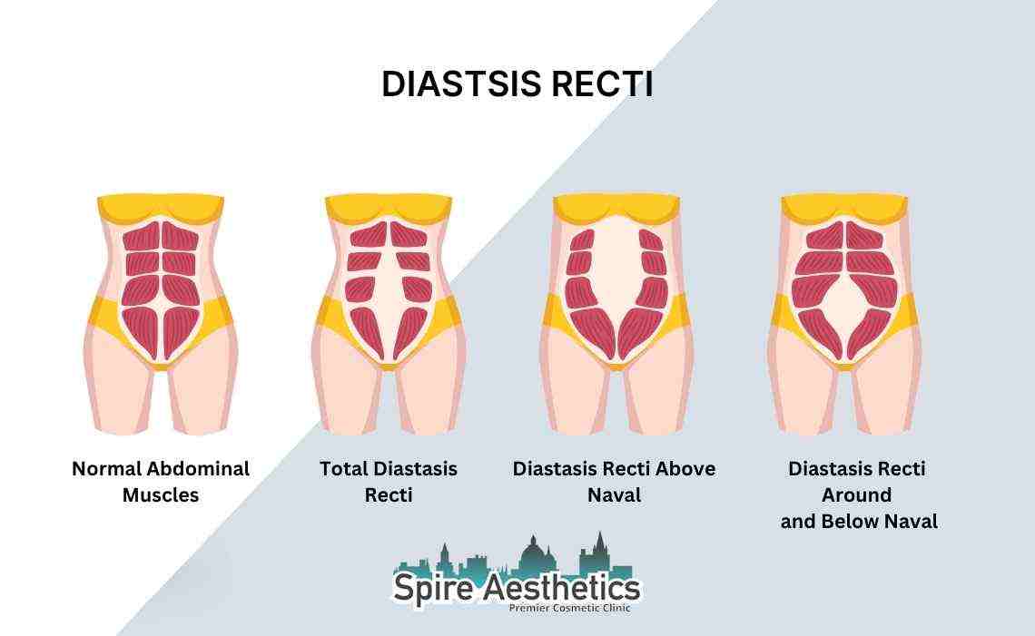 Is Non-Surgical Diastasis Recti Treatment Right for You? Common Concerns Answered Gloucestershire